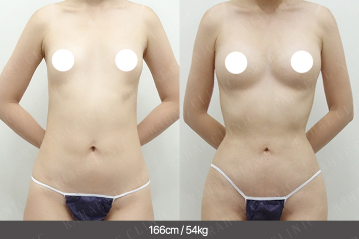 수술정보 <span>가슴지방이식+복부지방흡입+허벅지지방흡입