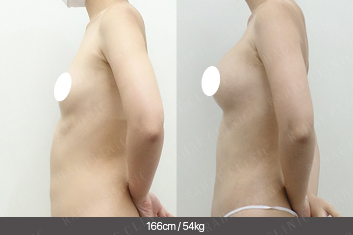 수술정보 <span>가슴지방이식+복부지방흡입+허벅지지방흡입