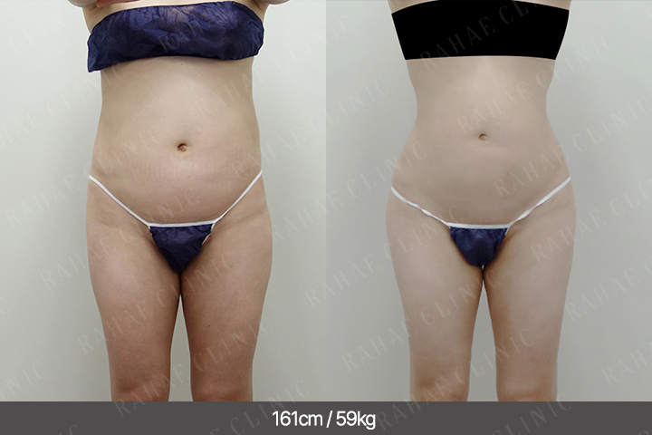 수술정보 <span>골반지방이식+엉덩이지방이식+허벅지지방흡입