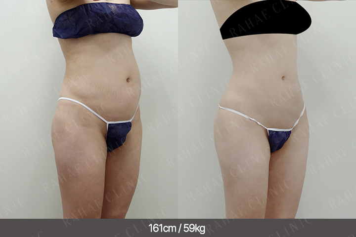 수술정보 <span>골반지방이식+엉덩이지방이식+허벅지지방흡입