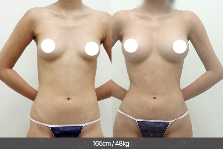 수술정보 <span>가슴지방이식+골반지방이식+엉덩이지방이식+복부지방흡입+허벅지지방흡입