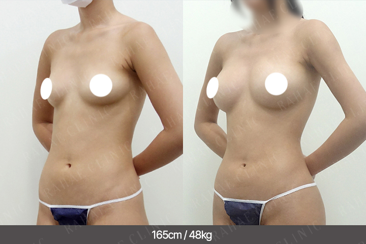 수술정보 <span>가슴지방이식+골반지방이식+엉덩이지방이식+복부지방흡입+허벅지지방흡입