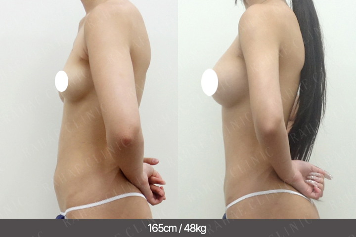 수술정보 <span>가슴지방이식+골반지방이식+엉덩이지방이식+복부지방흡입+허벅지지방흡입