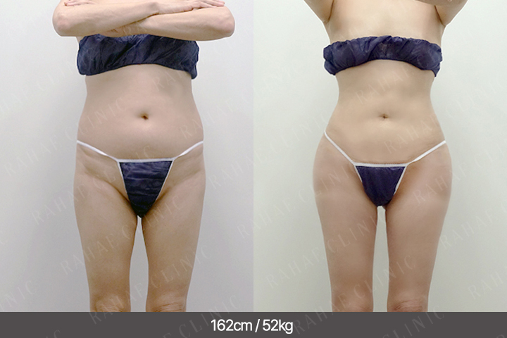 수술정보 <span>골반지방이식+엉덩이지방이식+복부지방흡입