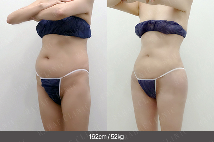 수술정보 <span>골반지방이식+엉덩이지방이식+복부지방흡입