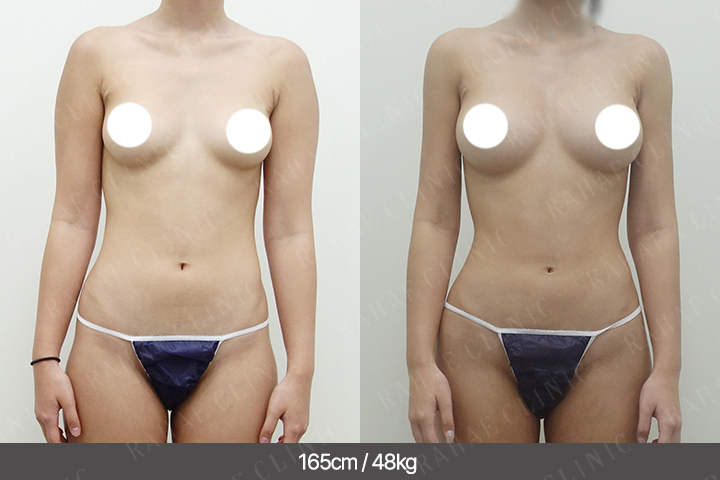 수술정보 <span>팔지방흡입골반+지방이식+엉덩이지방이식+복부지방흡입