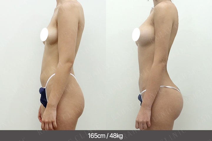 수술정보 <span>팔지방흡입골반+지방이식+엉덩이지방이식+복부지방흡입