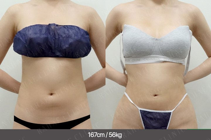 수술정보 <span>복부지방흡입+골반지방이식+엉덩이지방이식