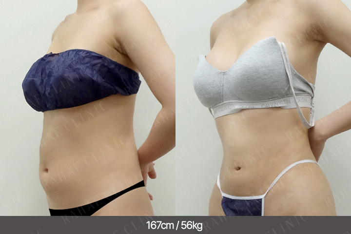 수술정보 <span>복부지방흡입+골반지방이식+엉덩이지방이식