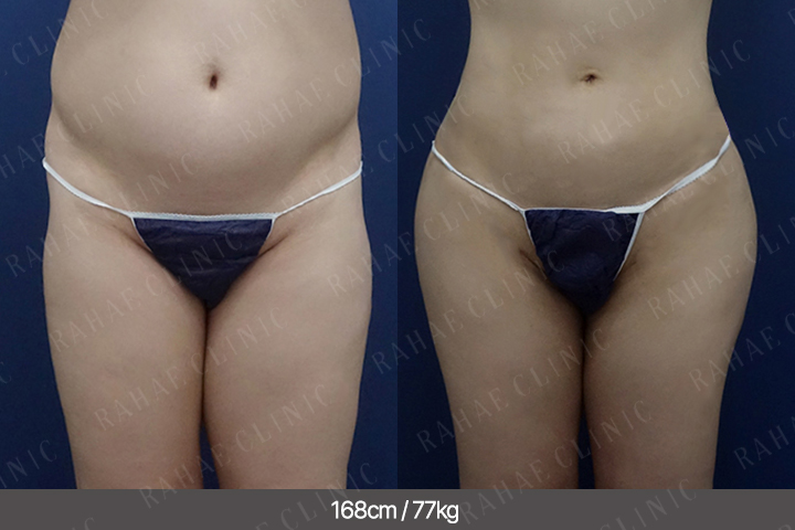 수술정보 <span>골반지방이식+엉덩이지방이식+가슴지방이식+복부지방흡입