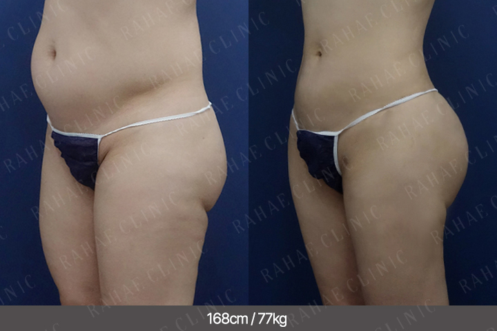 수술정보 <span>골반지방이식+엉덩이지방이식+가슴지방이식+복부지방흡입