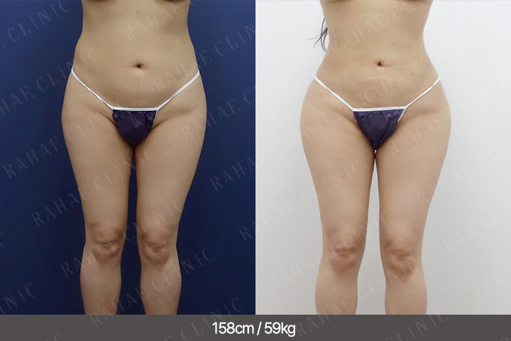 수술정보 <span>골반지방이식+엉덩이지방이식+복부지방흡입