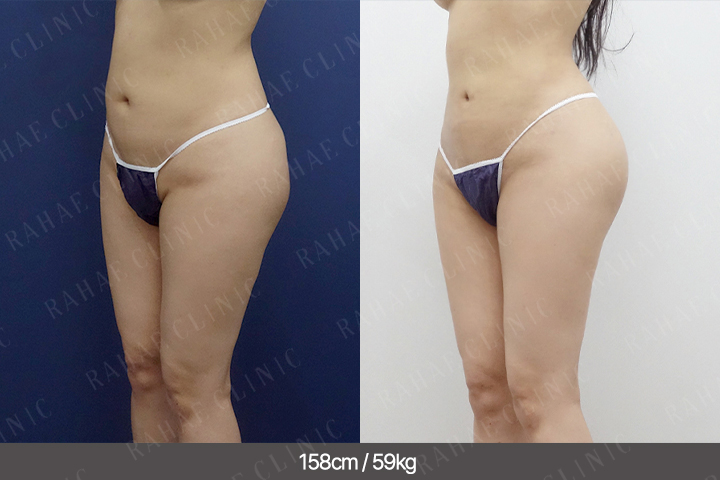 수술정보 <span>골반지방이식+엉덩이지방이식+복부지방흡입