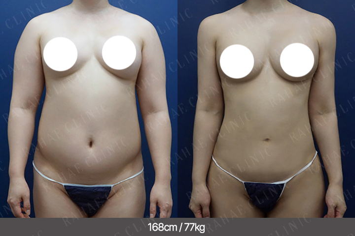 수술정보 <span>팔지방흡입+복부지방흡입+골반지방이식+엉덩이지방이식