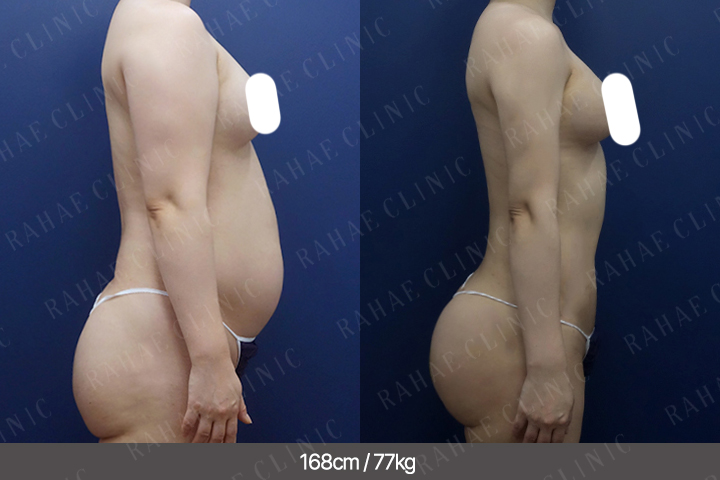 수술정보 <span>팔지방흡입+복부지방흡입+골반지방이식+엉덩이지방이식