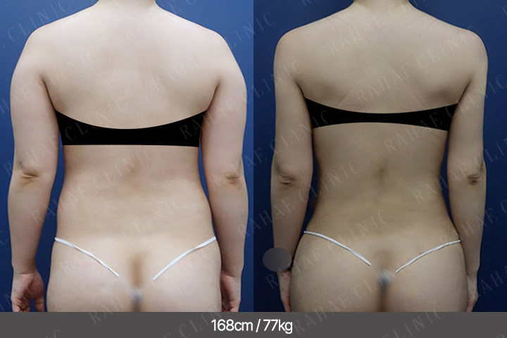 수술정보 <span>팔지방흡입+복부지방흡입+골반지방이식+엉덩이지방이식